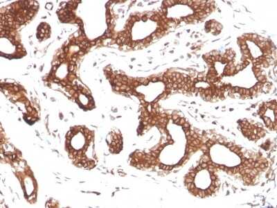 Immunohistochemistry-Paraffin: Calpastatin Antibody (CAST/1550) [NBP3-07397] - Formalin-fixed, paraffin-embedded human Breast Carcinoma stained with Calpastatin Mouse Monoclonal Antibody (CAST/1550).