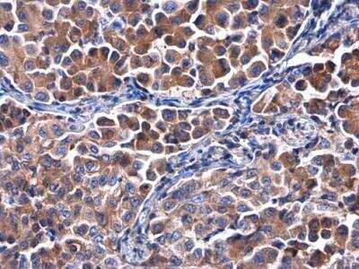 Immunohistochemistry-Paraffin: Calpastatin Antibody [NBP2-15678] -  Paraffin-embedded human lung cancer.  Calpastatin antibody diluted at 1:500.