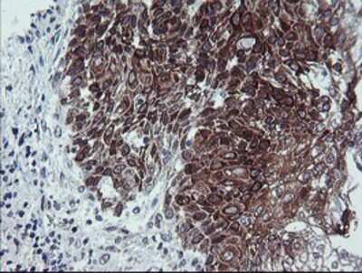 Immunohistochemistry: Calpastatin Antibody (OTI1E7) - Azide and BSA Free [NBP2-70338] - Staining of paraffin-embedded Carcinoma of Human bladder tissue using anti-Calpastatin mouse monoclonal antibody.