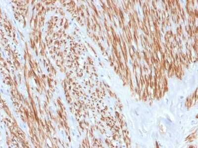 Immunohistochemistry-Paraffin: Calponin 1 Antibody (CNN1/4227R) - Azide and BSA Free [NBP3-08462] - Formalin-fixed, paraffin-embedded human leiomyosarcoma stained with Calponin 1 Rabbit Recombinant Monoclonal Antibody (CNN1/4227R).