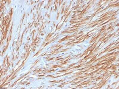 Immunohistochemistry-Paraffin: Calponin 1 Antibody (CNN1/4227R) - Azide and BSA Free [NBP3-08462] - Formalin-fixed, paraffin-embedded human leiomyosarcoma stained with Calponin 1 Rabbit Recombinant Monoclonal Antibody (CNN1/4227R).