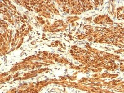 Immunohistochemistry-Paraffin: Calponin 1 Antibody (CNN1/832 + CALP) - Azide and BSA Free [NBP2-47758] - Human Breast Carcinoma stained with Calponin-1 Monoclonal Antibody (CNN1/832 + CALP).