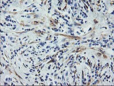 Immunohistochemistry-Paraffin: Calponin 2 Antibody (2B5) [NBP2-01325] - Staining of paraffin-embedded Carcinoma of Human lung tissue using anti-Calponin 2 mouse monoclonal antibody.
