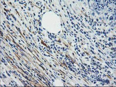 Immunohistochemistry-Paraffin: Calponin 2 Antibody (2B5) [NBP2-01325] - Staining of paraffin-embedded Carcinoma of Human pancreas tissue using anti-Calponin 2 mouse monoclonal antibody.