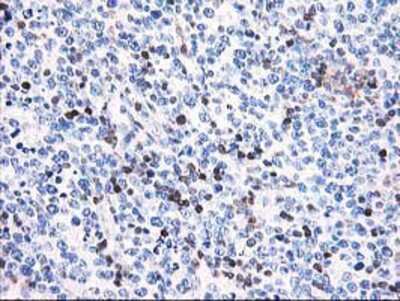 Immunohistochemistry-Paraffin: Calponin 2 Antibody (2B5) [NBP2-01325] - Staining of paraffin-embedded Human lymphoma tissue using anti-Calponin 2 mouse monoclonal antibody.