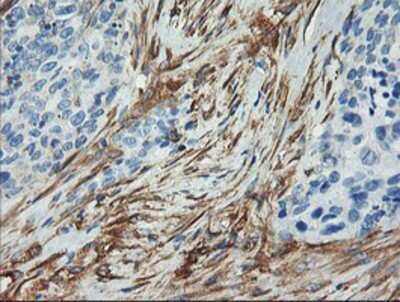 Immunohistochemistry: Calponin 2 Antibody (OTI2B5) - Azide and BSA Free [NBP2-70421] - Staining of paraffin-embedded Adenocarcinoma of Human breast tissue using anti-Calponin 2 mouse monoclonal antibody.