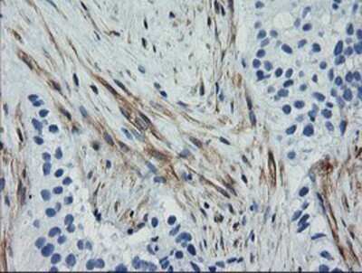 Immunohistochemistry: Calponin 2 Antibody (OTI2B5) - Azide and BSA Free [NBP2-70421] - Staining of paraffin-embedded Carcinoma of Human bladder tissue using anti-Calponin 2 mouse monoclonal antibody.
