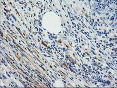 Immunohistochemistry: Calponin 2 Antibody (OTI2B5) - Azide and BSA Free [NBP2-70421] - Staining of paraffin-embedded Carcinoma of Human pancreas tissue using anti-Calponin 2 mouse monoclonal antibody.