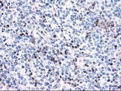 Immunohistochemistry: Calponin 2 Antibody (OTI2B5) - Azide and BSA Free [NBP2-70421] - Staining of paraffin-embedded Human lymphoma tissue using anti-Calponin 2 mouse monoclonal antibody.
