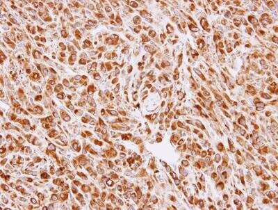 Immunohistochemistry-Paraffin: Calreticulin-2/CALR3 Antibody [NBP1-33337] - Paraffin-embedded OVCAR3 xenograft, using antibody at 1:100 dilution.