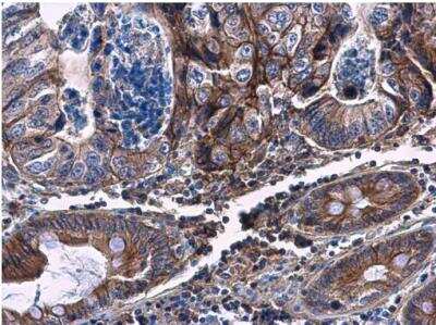 Immunohistochemistry-Paraffin: Carbohydrate Sulfotransferase 4/CHST4 Antibody [NBP2-15697] - Paraffin-embedded human colon carcinoma. CHST4 antibody [N3C3] diluted at 1:500.