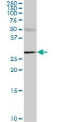 Western Blot: Carbonic Anhydrase I/CA1 Antibody (M2) [H00000759-M02] - CA1 monoclonal antibody (M02), clone M2. Analysis of CA1 expression in human lung cancer.