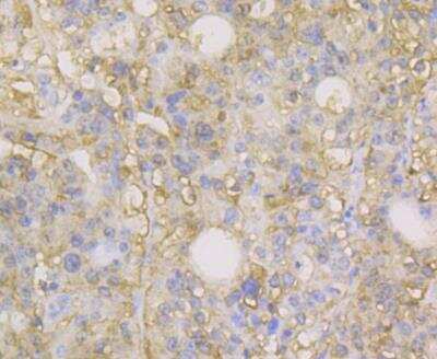Immunohistochemistry: Carbonic Anhydrase II/CA2 Antibody (11A1) [NBP2-76974] - Immunohistochemical analysis of paraffin-embedded human stomach cancer tissue using anti-Carbonic anhydrase 2 antibody. The section was pre-treated using heat mediated antigen retrieval with Tris-EDTA buffer (pH 8.0-8.4) for 20 minutes.The tissues were blocked in 5% BSA for 30 minutes at room temperature, washed with ddH2O and PBS, and then probed with the antibody at 1/100 dilution, for 30 minutes at room temperature and detected using an HRP conjugated compact polymer system. DAB was used as the chrogen. Counter stained with hematoxylin and mounted with DPX.