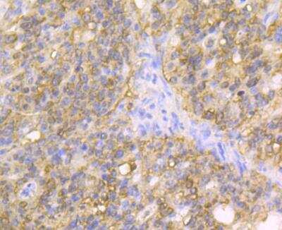 Immunohistochemistry: Carbonic Anhydrase II/CA2 Antibody (11A2) [NBP2-76824] - Immunohistochemical analysis of paraffin-embedded human stomach cancer tissue using anti-Carbonic anhydrase 2 antibody. The section was pre-treated using heat mediated antigen retrieval with Tris-EDTA buffer (pH 8.0-8.4) for 20 minutes.The tissues were blocked in 5% BSA for 30 minutes at room temperature, washed with ddH2O and PBS, and then probed with the antibody at 1/100 dilution, for 30 minutes at room temperature and detected using an HRP conjugated compact polymer system. DAB was used as the chrogen. Counter stained with hematoxylin and mounted with DPX.
