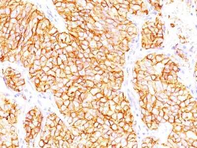 Immunohistochemistry-Paraffin: Carbonic Anhydrase IX/CA9 Antibody (66.4.C2 (PN-15)) - Azide and BSA Free [NBP2-33152] - FFPE human renal cell carcinoma stained with RCC Ab (66.4.C2).  Note cytoplasmic & cell surface staining of tumor cells.