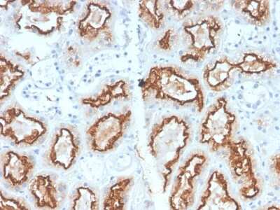 Immunohistochemistry-Paraffin: Carbonic Anhydrase IX/CA9 Antibody (CA9/2993R) - Azide and BSA Free [NBP3-08407] - Formalin-fixed, paraffin-embedded human Renal Cell Carcinoma stained with Carbonic Anhydrase IX/CA9 Rabbit Recombinant Monoclonal Antibody (CA9/2993R).