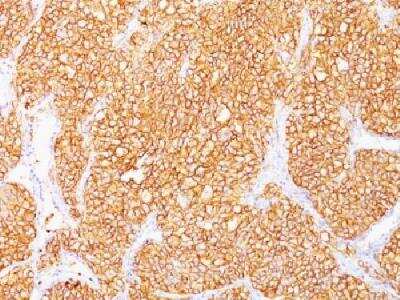 Immunohistochemistry-Paraffin: Carbonic Anhydrase IX/CA9 Antibody (SPM314) [NBP2-34360] - FFPE human renal cell carcinoma stained with RCC MAb (SPM314). Note cytoplasmic & cell surface staining of tumor cells.