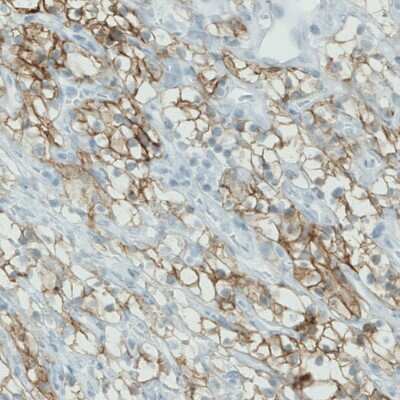 Immunohistochemistry-Paraffin: Carbonic Anhydrase XII/CA12 Antibody (CL0278) [NBP2-52901] - Staining of human renal cancer shows membranous positivity in tumor cells.