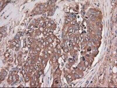 Immunohistochemistry: Carboxypeptidase A1/CPA1 Antibody (OTI2A3) - Azide and BSA Free [NBP2-70431] - Staining of paraffin-embedded Adenocarcinoma of ovary using anti-Carboxypeptidase A mouse monoclonal antibody.