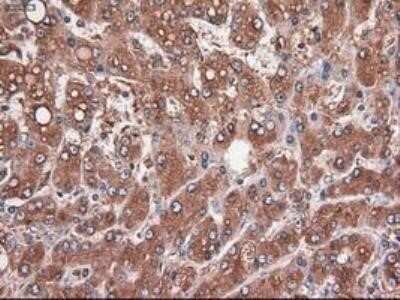 Immunohistochemistry: Carboxypeptidase A1/CPA1 Antibody (OTI2A3) - Azide and BSA Free [NBP2-70431] - Staining of paraffin-embedded Carcinoma of pancreas using anti-Carboxypeptidase A mouse monoclonal antibody.