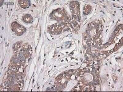 Immunohistochemistry: Carboxypeptidase A1/CPA1 Antibody (OTI2A3) - Azide and BSA Free [NBP2-70431] - Staining of paraffin-embedded Adenocarcinoma of breast using anti-Carboxypeptidase A mouse monoclonal antibody.