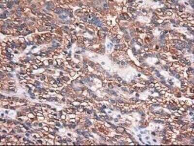 Immunohistochemistry: Carboxypeptidase A1/CPA1 Antibody (OTI2A3) - Azide and BSA Free [NBP2-70431] - Staining of paraffin-embedded Carcinoma of kidney using anti-Carboxypeptidase A mouse monoclonal antibody.