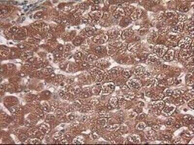 Immunohistochemistry: Carboxypeptidase A1/CPA1 Antibody (OTI2A3) - Azide and BSA Free [NBP2-70431] - Staining of paraffin-embedded Carcinoma of liver using anti-Carboxypeptidase A mouse monoclonal antibody.