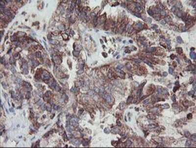 Immunohistochemistry-Paraffin: Carboxypeptidase A2 Antibody (1C7) [NBP2-01992] - Staining of paraffin-embedded Adenocarcinoma of Human ovary tissue using anti-Carboxypeptidase A2 mouse monoclonal antibody.