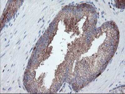 Immunohistochemistry: Carboxypeptidase A2/CPA2 Antibody (OTI1C7) - Azide and BSA Free [NBP2-70440] - Staining of paraffin-embedded Carcinoma of Human prostate tissue using anti-Carboxypeptidase A2 mouse monoclonal antibody.