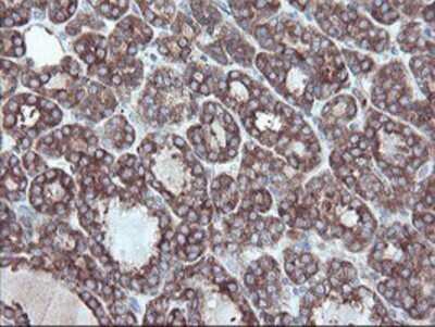 Immunohistochemistry: Carboxypeptidase A2/CPA2 Antibody (OTI1C7) - Azide and BSA Free [NBP2-70440] - Staining of paraffin-embedded Carcinoma of Human thyroid tissue using anti-Carboxypeptidase A2 mouse monoclonal antibody.