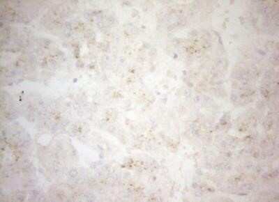 Immunohistochemistry: Carboxypeptidase M Antibody (OTI2D11) - Azide and BSA Free [NBP2-70446] - Staining of paraffin-embedded Carcinoma of Human liver tissue using anti-CPM mouse monoclonal antibody.(Heat-induced epitope retrieval by 1mM EDTA in 10mM Tris buffer (pH8.5) at 120 degrees C for 3 min,)(1:150)