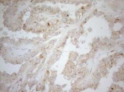 Immunohistochemistry: Carboxypeptidase M Antibody (OTI2D11) - Azide and BSA Free [NBP2-70446] - Staining of paraffin-embedded Carcinoma of Human thyroid tissue using anti-CPM mouse monoclonal antibody.(Heat-induced epitope retrieval by 1mM EDTA in 10mM Tris buffer (pH8.5) at 120 degrees C for 3 min,)(1:150).