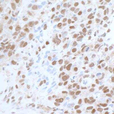 Immunohistochemistry-Paraffin: Carm1 Antibody [NB200-342] - Detection of human CARM1 by immunohistochemistry. Sample: FFPE section of human breast carcinoma. Antibody: Affinity purified rabbit anti-CARM1 (Cat. No. A300-421A lot 4) used at 1:1,000 (1ug/ml). Detection: DAB