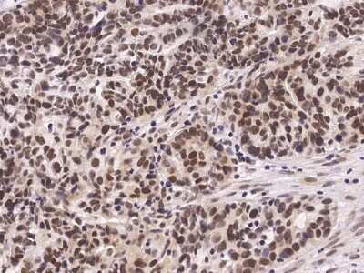 Immunohistochemistry-Paraffin: Carm1 Antibody [NBP2-98754] - Immunochemical staining of human Carm1 in human ovarian cancer with rabbit polyclonal antibody (1:2000, formalin-fixed paraffin embedded sections).