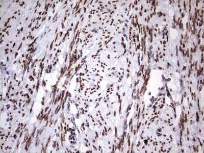 Immunohistochemistry: Casein Kinase 1 epsilon Antibody (5D4) [NBP2-46377] - Analysis of Adenocarcinoma of Human endometrium tissue. (Heat-induced epitope retrieval by 1 mM EDTA in 10mM Tris, pH8.5, 120C for 3min)