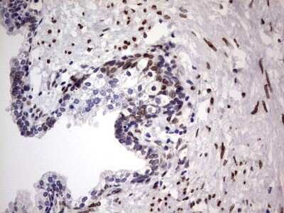 Immunohistochemistry: Casein Kinase 1 epsilon Antibody (5D4) [NBP2-46377] - Analysis of Carcinoma of Human prostate tissue. (Heat-induced epitope retrieval by 1 mM EDTA in 10mM Tris, pH8.5, 120C for 3min)