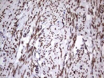 Immunohistochemistry: Casein Kinase 1 epsilon Antibody (OTI5D4) - Azide and BSA Free [NBP2-70464] - Analysis of Adenocarcinoma of Human endometrium tissue. (Heat-induced epitope retrieval by 1 mM EDTA in 10mM Tris, pH8.5, 120C for 3min)