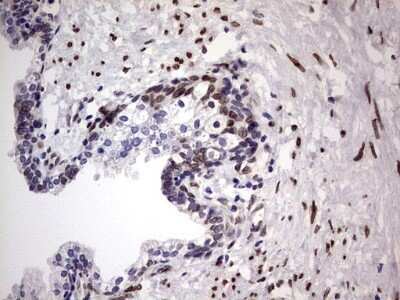 Immunohistochemistry: Casein Kinase 1 epsilon Antibody (OTI5D4) - Azide and BSA Free [NBP2-70464] - Analysis of Carcinoma of Human prostate tissue. (Heat-induced epitope retrieval by 1 mM EDTA in 10mM Tris, pH8.5, 120C for 3min)