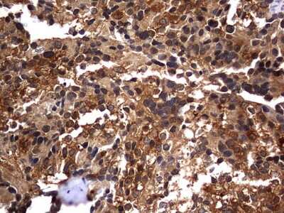 Immunohistochemistry: Casein Kinase 1 gamma 2 Antibody (4H3) [NBP2-46385] - Analysis of Adenocarcinoma of Human breast tissue. (Heat-induced epitope retrieval by 1 mM EDTA in 10mM Tris, pH8.5, 120C for 3min)