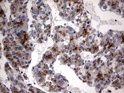 Immunohistochemistry: Casein Kinase 1 gamma 2 Antibody (4H3) [NBP2-46385] - Analysis of Carcinoma of Human liver tissue. (Heat-induced epitope retrieval by 1 mM EDTA in 10mM Tris, pH8.5, 120C for 3min)