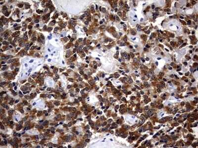 Immunohistochemistry: Casein Kinase 1 gamma 2 Antibody (4H3) [NBP2-46385] - Analysis of Carcinoma of Human pancreas tissue. (Heat-induced epitope retrieval by 1 mM EDTA in 10mM Tris, pH8.5, 120C for 3min)