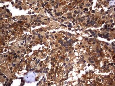 Immunohistochemistry: Casein Kinase 1 gamma 2 Antibody (OTI4H3) - Azide and BSA Free [NBP2-70465] - Analysis of Adenocarcinoma of Human breast tissue. (Heat-induced epitope retrieval by 1 mM EDTA in 10mM Tris, pH8.5, 120C for 3min)
