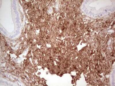 Immunohistochemistry: Casein Kinase 1 gamma Antibody (4D9) [NBP2-46384] - Analysis of Carcinoma of Human pancreas tissue. (Heat-induced epitope retrieval by 1 mM EDTA in 10mM Tris, pH8.5, 120C for 3min)