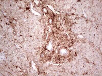 Immunohistochemistry: Casein Kinase 1 gamma Antibody (4D9) [NBP2-46384] - Analysis of Adenocarcinoma of Human endometrium tissue. (Heat-induced epitope retrieval by 1 mM EDTA in 10mM Tris, pH8.5, 120C for 3min)
