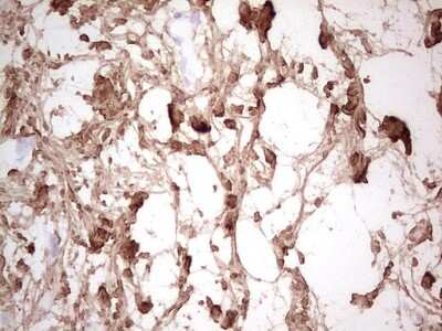 Immunohistochemistry: Casein Kinase 1 gamma Antibody (4D9) [NBP2-46384] - Analysis of Carcinoma of Human bladder tissue. (Heat-induced epitope retrieval by 1 mM EDTA in 10mM Tris, pH8.5, 120C for 3min)
