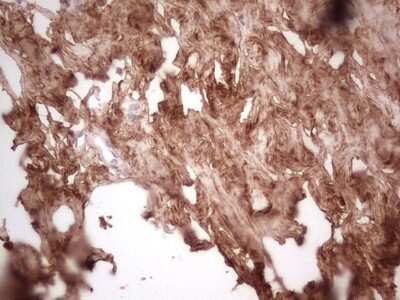 Immunohistochemistry: Casein Kinase 1 gamma Antibody (OTI4D9) - Azide and BSA Free [NBP2-71948] - Analysis of Adenocarcinoma of Human breast tissue. (Heat-induced epitope retrieval by 1 mM EDTA in 10mM Tris, pH8.5, 120C for 3min)