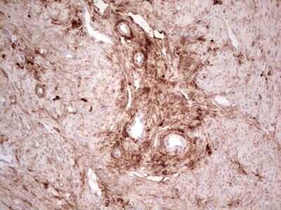 Immunohistochemistry: Casein Kinase 1 gamma Antibody (OTI4D9) - Azide and BSA Free [NBP2-71948] - Analysis of Adenocarcinoma of Human endometrium tissue. (Heat-induced epitope retrieval by 1 mM EDTA in 10mM Tris, pH8.5, 120C for 3min)