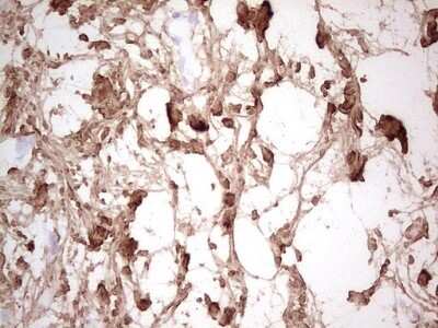Immunohistochemistry: Casein Kinase 1 gamma Antibody (OTI4D9) - Azide and BSA Free [NBP2-71948] - Analysis of Carcinoma of Human bladder tissue. (Heat-induced epitope retrieval by 1 mM EDTA in 10mM Tris, pH8.5, 120C for 3min)