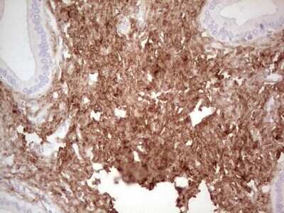 Immunohistochemistry: Casein Kinase 1 gamma Antibody (OTI4D9) - Azide and BSA Free [NBP2-71948] - Analysis of Carcinoma of Human pancreas tissue. (Heat-induced epitope retrieval by 1 mM EDTA in 10mM Tris, pH8.5, 120C for 3min)