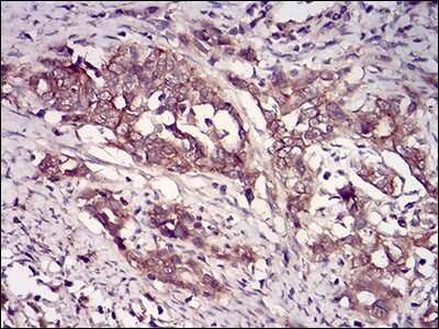 Immunohistochemistry: Casein Kinase 2 beta Antibody (2F12F3) [NBP2-52449] - Analysis of paraffin-embedded cervical cancer tissues using CSNK2B mouse mAb with DAB staining.